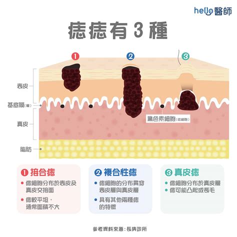 臉 痣|為什麼臉上的痣越來越多？皮膚科醫師解析長痣原因、。